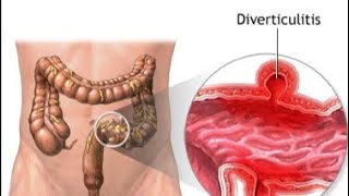 Diverticulitis  Causes Types Symptoms and Treatment [upl. by Ecikram]