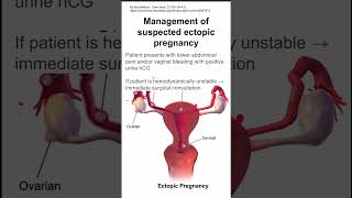 Management of suspected ectopic pregnancy [upl. by Yhtommit638]