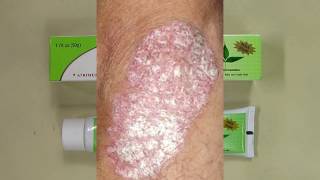 REVIEW Sorion Natural Moisturizing Cream  Psoriasis Skin Care with Coconut Oil and Neem [upl. by Lawson869]