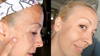 ELIMINAR las MANCHAS o paños de la piel  MELASMA [upl. by Yrolam]