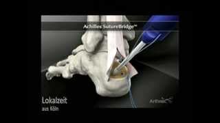 AchillessehnenEntzündung Neue Operationsmethode ORTHOPARC Klinik [upl. by Eeralih]