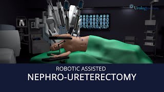 Robot Assisted NephroUreterectomy [upl. by Yssac]