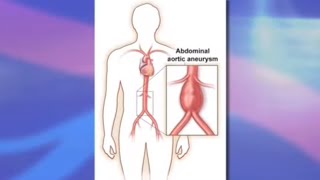 Risks and Benefits of Endovascular Abdominal Aortic Aneurysm Repair EVAR [upl. by Haliek85]