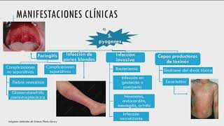 Sesión clínica Retos del Streptococcus Pyogenes en el puerperio [upl. by Yzzo]