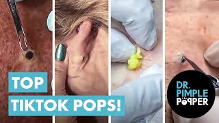 Dr Pimple Popper’s Top 10 Tiktok Pops [upl. by Anissej]