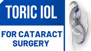 Toric IOL For Cataract Surgery [upl. by Puritan]