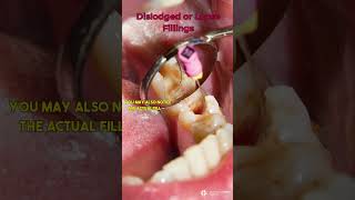 Dislodged or Loose Fillings dentist filling [upl. by Eetse]