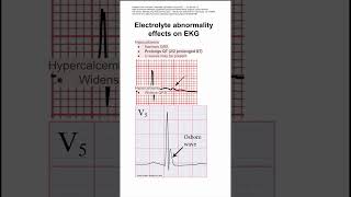 Electrolyte abnormality effects on EKG [upl. by Puna]