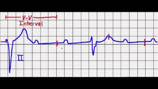 Cardiac Pacing Failure to CaptureFailure to Sense [upl. by Anayra]