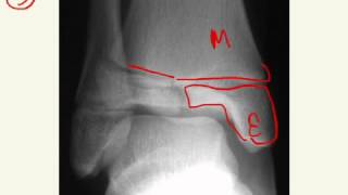 SalterHarris Fractures Answers [upl. by Mighell489]