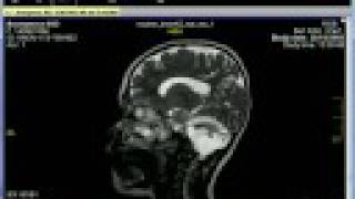 IQ view Workstation dicom Risonanza [upl. by Jehanna210]