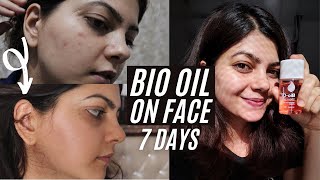 I applied Bio Oil on my face for 7 days How to remove pimples in 7 days [upl. by Natalia]