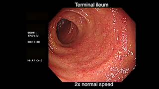 DEEP BACKWASH ILEITIS AND ULCERATIVE COLITIS [upl. by Llertnod]