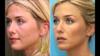 The difference between Botox or Dermal Fillers amp how they work The Medical Skin Clinic [upl. by Aiouqahs]