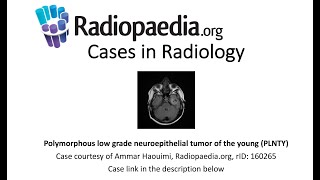 Polymorphous low grade neuroepithelial tumor of the young PLNTY Radiopaediaorg Cases in Radiology [upl. by Barina565]