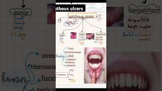 Aphthous ulcers dental dentistrydegree dentistdoctor dentistrystudent [upl. by Boot]