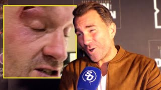 TYSON FURY GOT SOMEONE TO CUT HIM RIDICULOUS  Eddie Hearn REACTS to postponement [upl. by Ecnarretal]