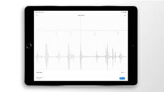 Atrial Fibrillation Combined Heart Sound PCG amp ECG Example  EkoCLINIC App [upl. by Grier]