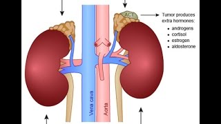 Primary Aldosteronism [upl. by Court]