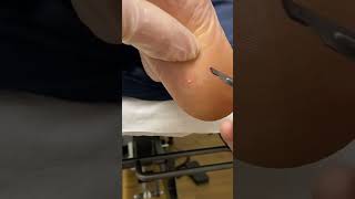 Expert Australian Podiatrist Removes Painful Corns with Precision [upl. by Verdie219]