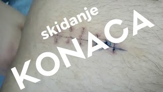 Skidanje ĹĄavova konaca nakon operacijesivenjausivanja [upl. by Goodden]