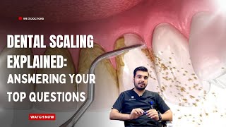 Answering your top questions about Dental Scaling  Teeth whitening  Oral Hygiene [upl. by Tynan]