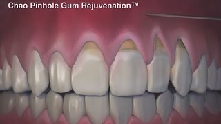 Less Invasive Procedure For Receding Gums 5316 [upl. by Laenahtan]