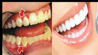 Comment Blanchir Ses Dents En 2 Minutes Avoir Un Tres Beau Sourire [upl. by Schilt]