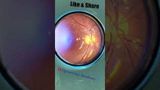 Smartphone Fundus Videography  Fundus Photography  Short Video 21 [upl. by Anairt492]