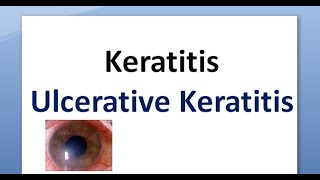 Ophthalmology 110 a Keratitis Cornea Inflammation Corneal Ulcer Ulcerative Ulceration [upl. by Demetri]