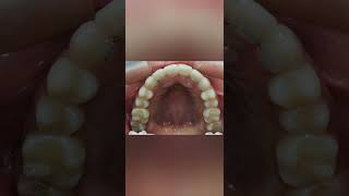 Ortodoncia  brackets en 18 citas el antes y despues Brackets Ortodoncia Dental Odontologo [upl. by Llewxam567]