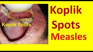 Koplik Spots in Measles [upl. by Krigsman]