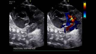 PATENT DUCTUS ARTERIOSUS LEFT HEART DILATION [upl. by Dalston732]