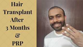 Hair Transplant after 3 months and PRP [upl. by Melburn]