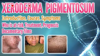 Xeroderma pigmentosum causes symptoms treatment prognosis documentary pronunciation  XP [upl. by Tomlinson]