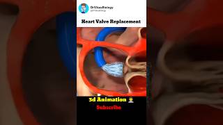 Heart Valve Replacement Procedure 👨‍⚕️ [upl. by O'Shee815]