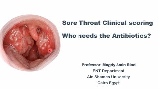 Sore Throat Clinical scoring Who needs the Antibiotics [upl. by Davon]