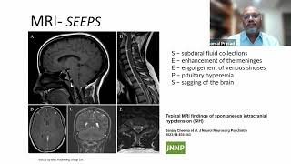 Spontaneous Intracranial Hypotension  Dr Komal Prasad Chandrachari [upl. by Lorrie496]