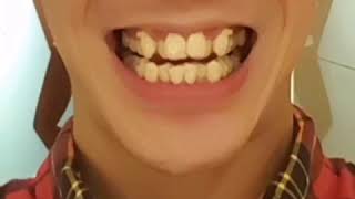 Apparecchio invisibile Invisalign A Bari Studio dentistico Specializzato [upl. by Rimisac]