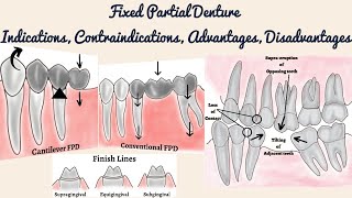 Fixed Partial Denture  Indications Contraindications Advantages and Disadvantages FPD Overview [upl. by Frasquito]