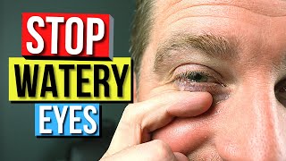 How To STOP EYES From WATERING  Top 5 Causes and Remedies For Watery Eyes [upl. by Telrats]