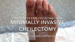 Minimally Invasive Cheilectomy For Hallux Rigidus [upl. by Riva]