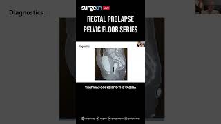 Sevent Episode of the Pelvic Floor Series Rectal Prolapse [upl. by Eannyl]