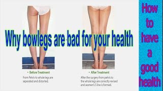 Bow legs treatment  Why bowlegs are bad for your health [upl. by Varhol]