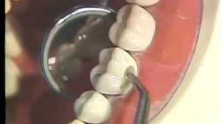 Packing and Carving of Class I and V Amalgam for Hygienists [upl. by Llegna]