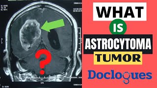 What is Astrocytoma Tumor [upl. by Annoved311]