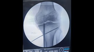 MEDIAL MENISCUS ROOT TRANSTIBIAL PULL OUT REPAIR [upl. by Esirahc]