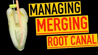 Managing a Joining root canal  4K Resolution [upl. by Shwalb1]