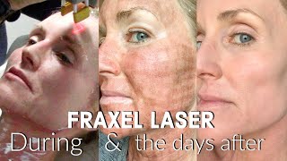 My FRACTIONAL CO2 LASER Experience  The FULL Treatment amp the DAYS following  BEFORE amp AFTER Fraxel [upl. by Cromwell]