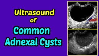 Ultrasound of Common Adnexal Cysts [upl. by Nowd]